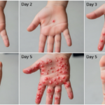 early signs hand foot and mouth day by day